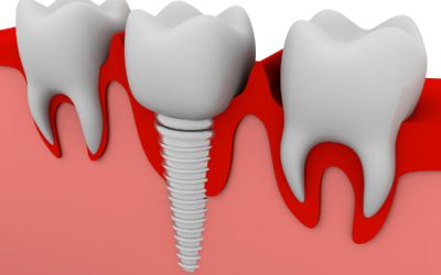 CONSEJOS TRAS UNA INTERVENCION DE IMPLANTES