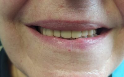 Carga inmediata en paciente con fagofobia | Caso clínico