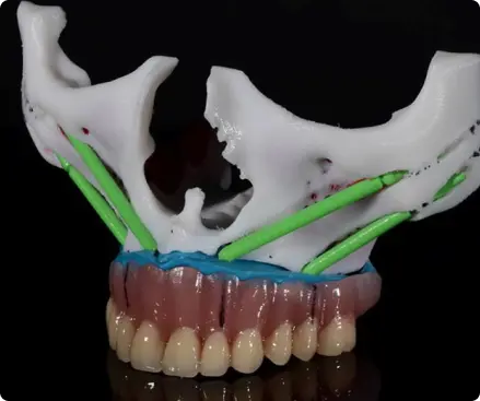 Implantes Zigomáticos
