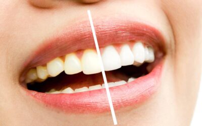 Mitos de la odontología: El blanqueamiento dental