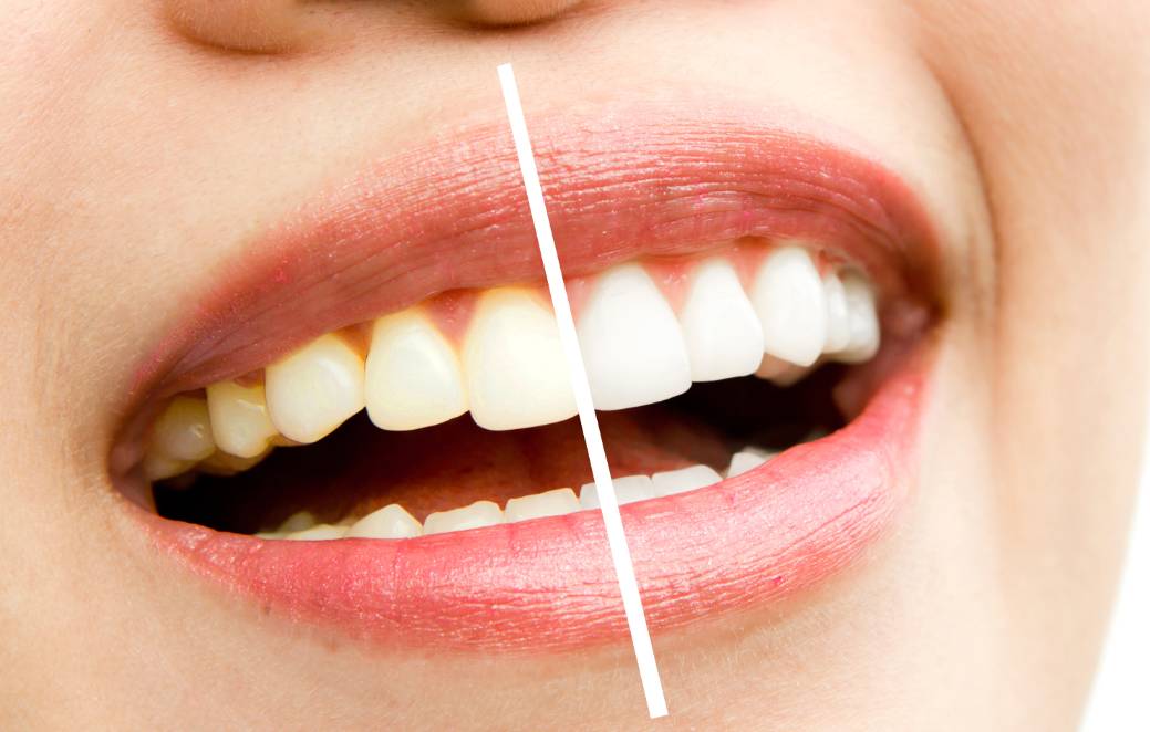Mitos de la odontología: El blanqueamiento dental