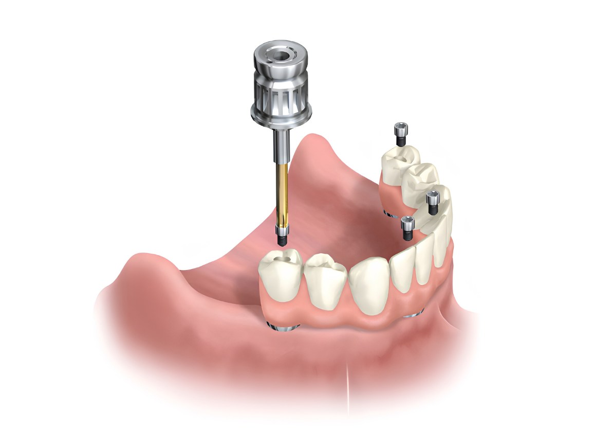Sistema de carga inmediata en Clínica Dental Aldaz