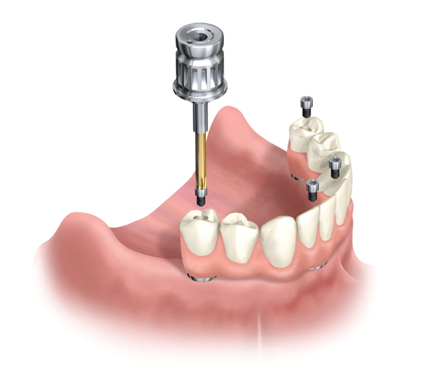 En esta imagen se muestra la colocación de la prótesis y su anclaje a los implantes. Sistema all-on-four