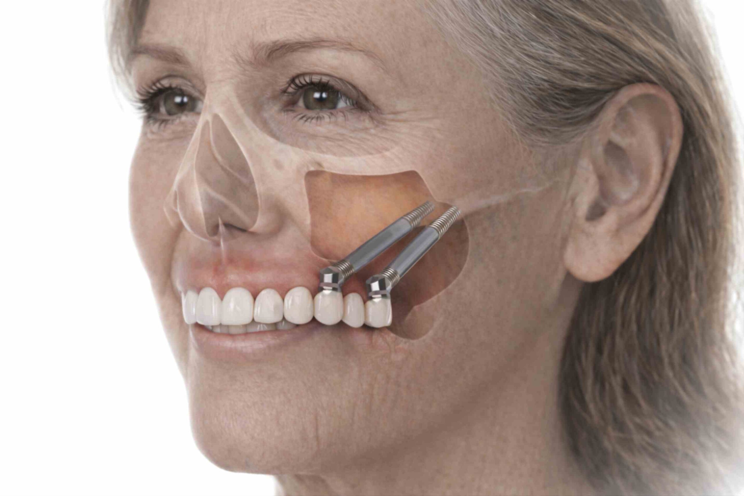 Paciente con implantes cigomaticos colocados