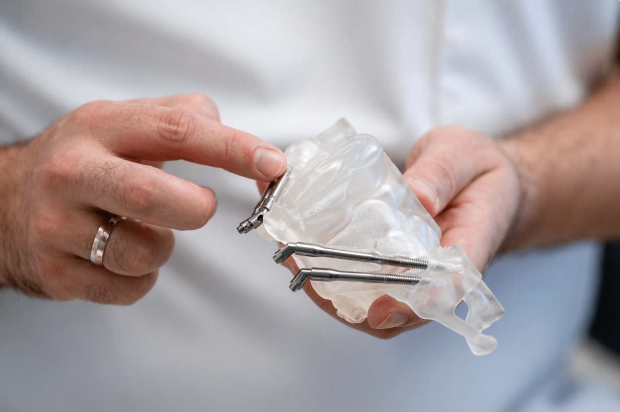 Cigomaticos Paciente con implantes cigomaticos colocados