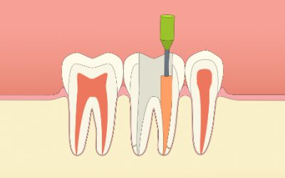 ODONTOLOGIAREN MITO FALTSUAK. ENDODONTZIA