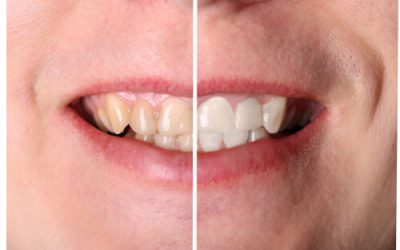 MITOS DE LA ODONTOLOGIA: EL BLANQUEAMIENTO DENTAL