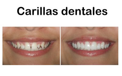 ESTETICA DENTAL. LAS CARILLAS