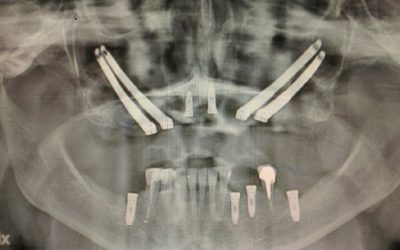 IMPLANTES ZIGOMATICOS. CASO PRACTICO