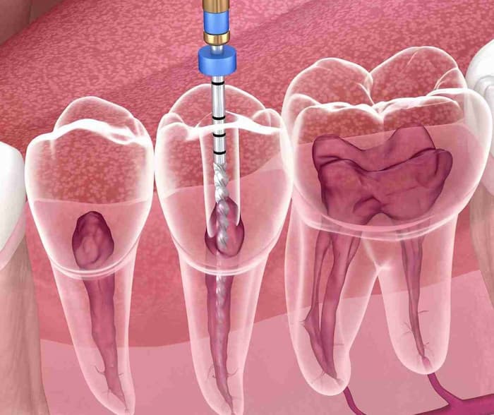 Endodoncias
