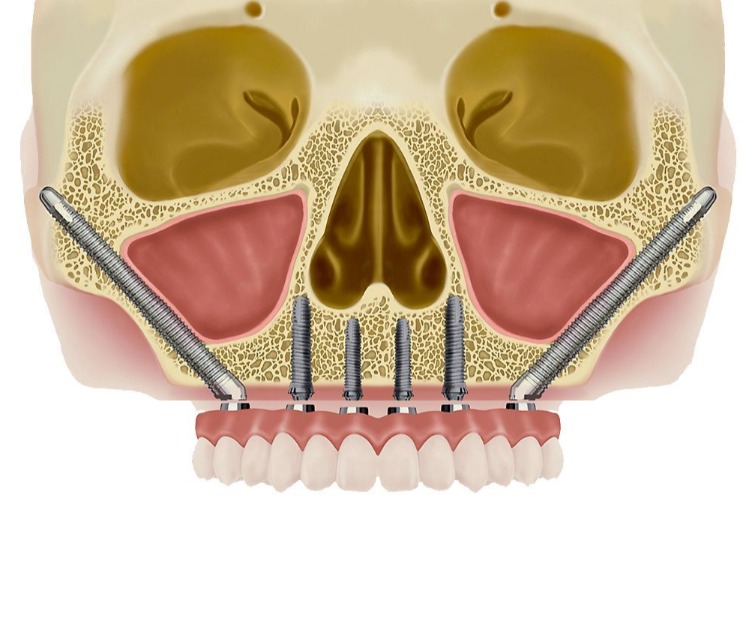 implantes zigomáticos en maxilar atrófico