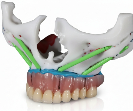 implantes cigomáticos colocados en modelo