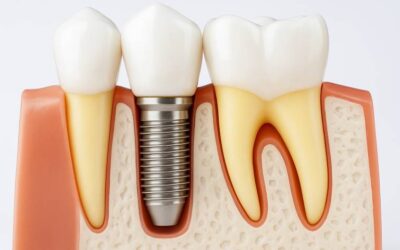 Implantes dentales: Todo lo que necesitas saber para recuperar tu sonrisa