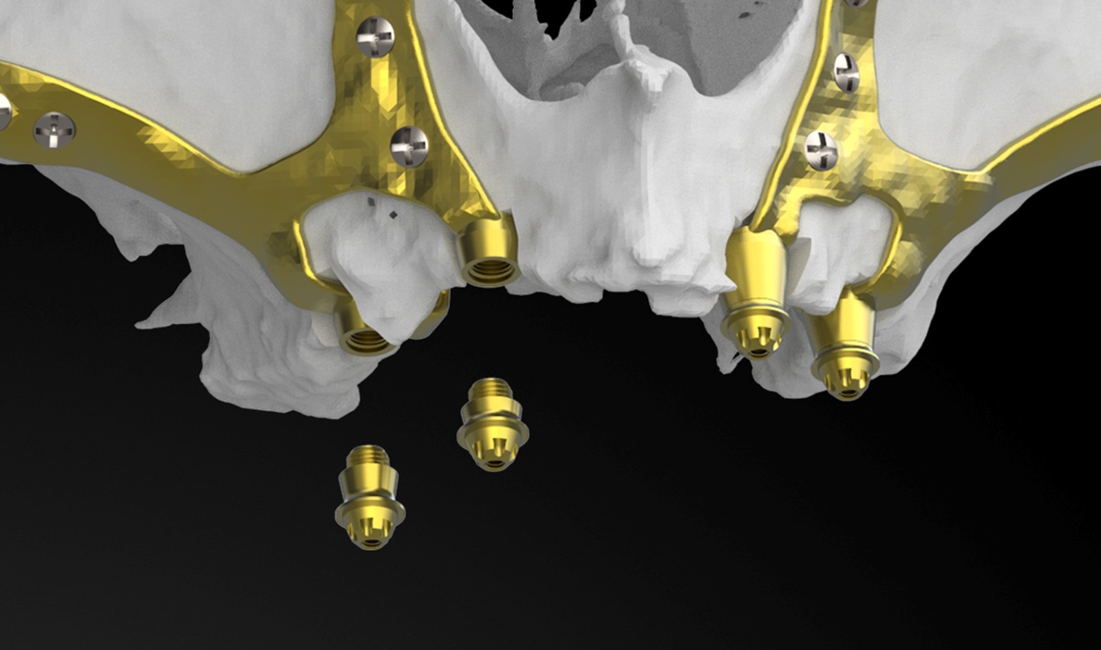 Implantes Mallas Subperiosticos