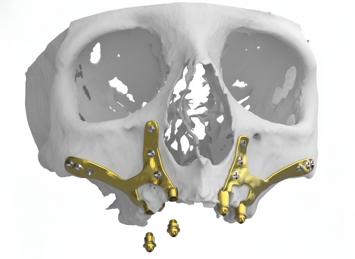Implantes Subperiosticos Modelo de implantes subperiósticos personalizados colocados sobre el hueso maxilar en casos de atrofia ósea severa