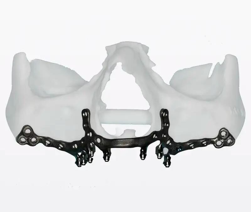 Implantes subperiósticos: la solución avanzada cuando no hay hueso suficiente | Clínica Dental Aldaz