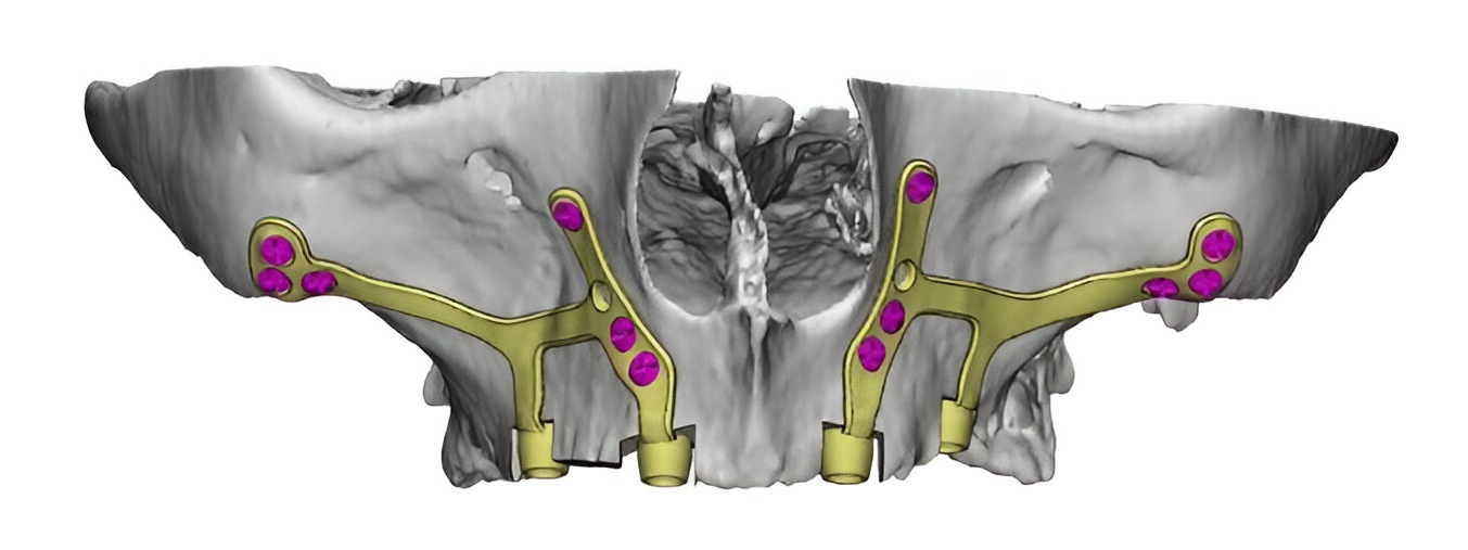 Implantes Subperiosticos Personalizados Diseño digital de implantes subperiósticos personalizados adaptados al hueso maxilar en casos de atrofia ósea severa