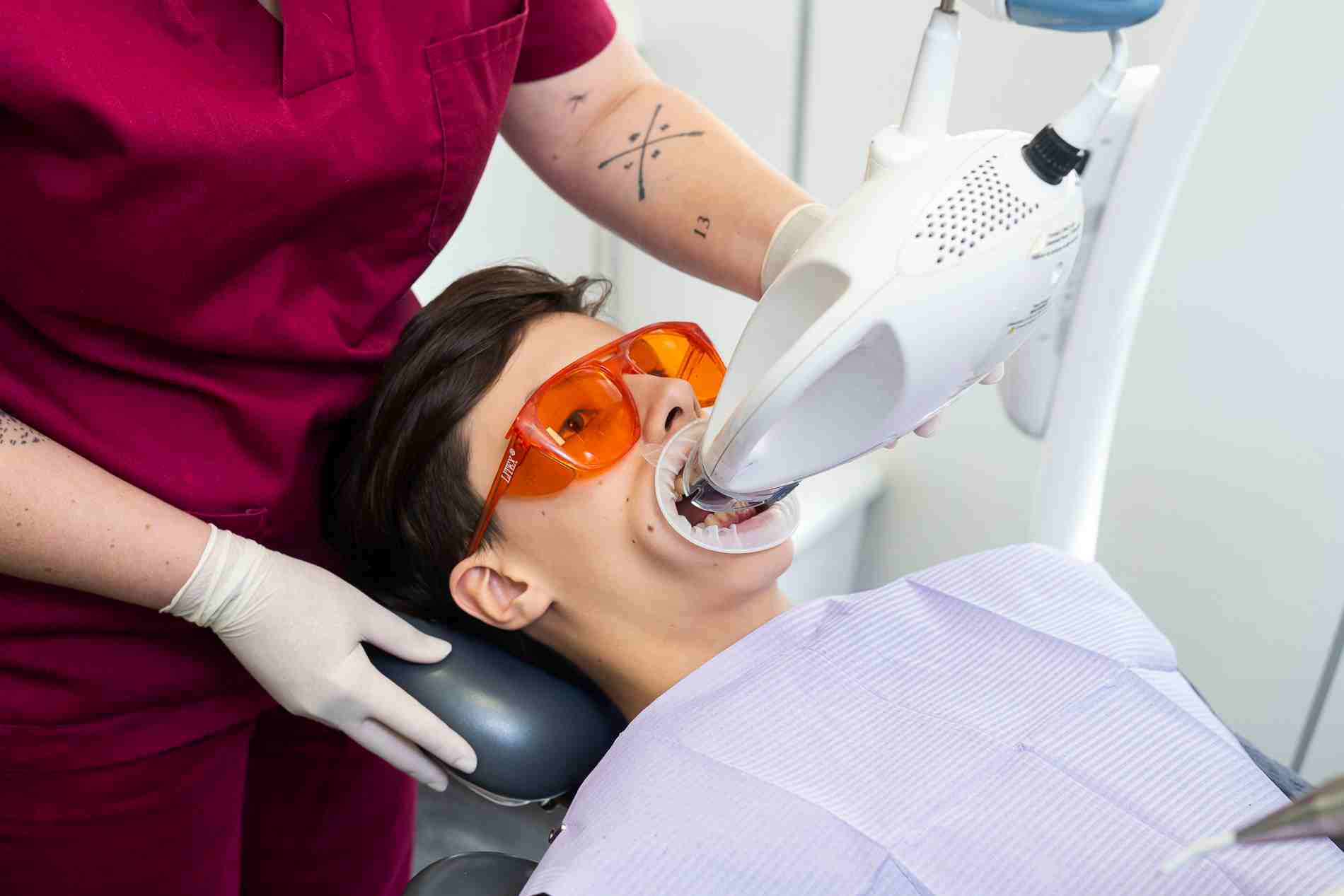 Blanqueamiento con luz ultravioleta en Clínica Dental Aldaz