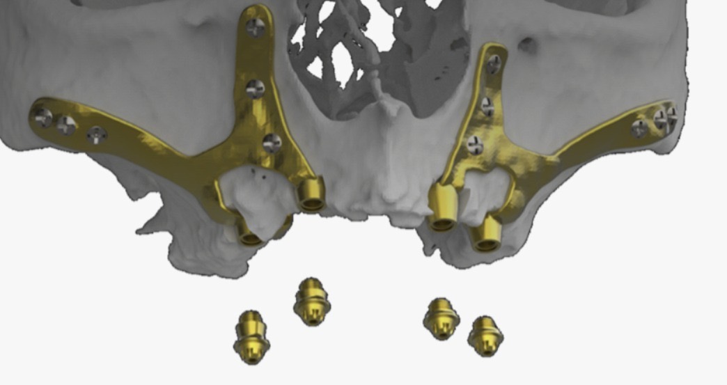 Mallas Implantes Subperiosticos