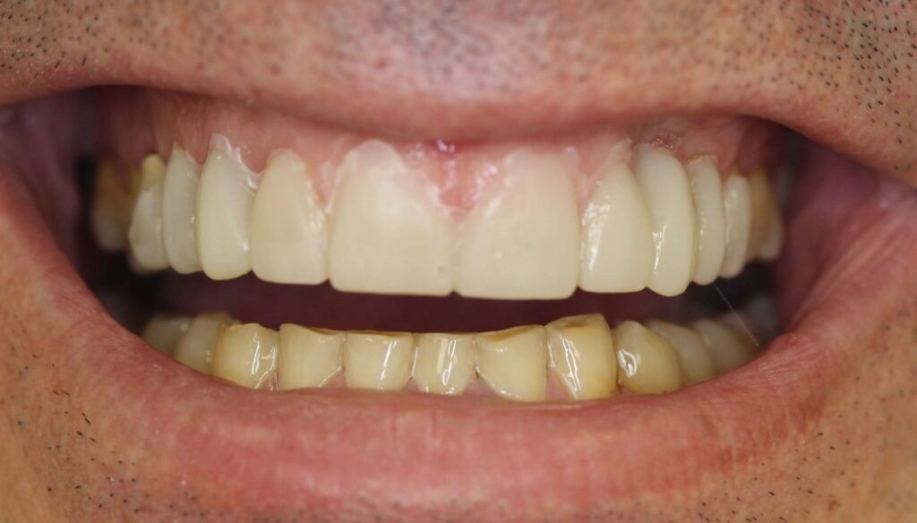 mock-up digital CAD-CAM en desgaste dental