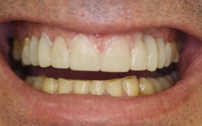 Rehabilitación dental por desgaste severo | Clínica Dental Aldaz