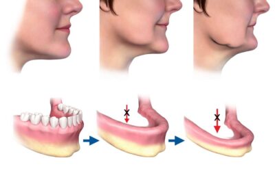 Me han dicho que no tengo hueso: ¿qué opciones existen hoy en día?